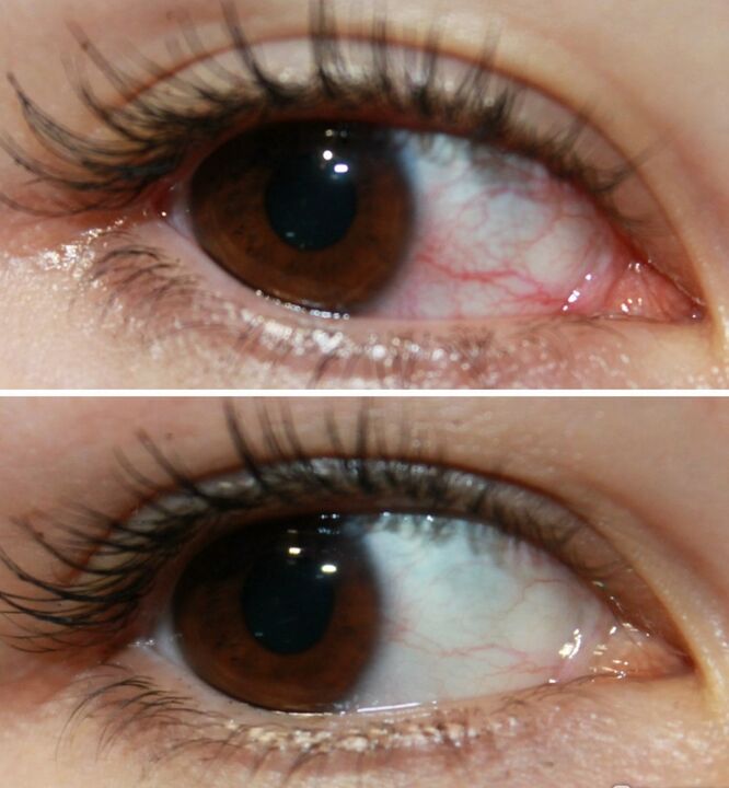 Ocuvit działa bardzo szybko